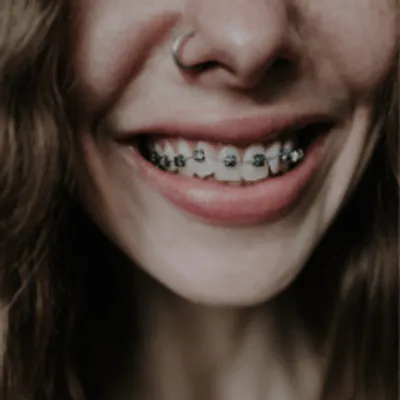 Logopedia ortodontyczna